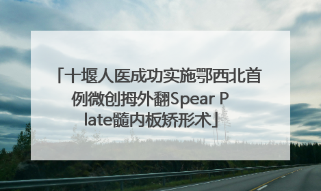 十堰人医成功实施鄂西北首例微创拇外翻Spear Plate髓内板矫形术